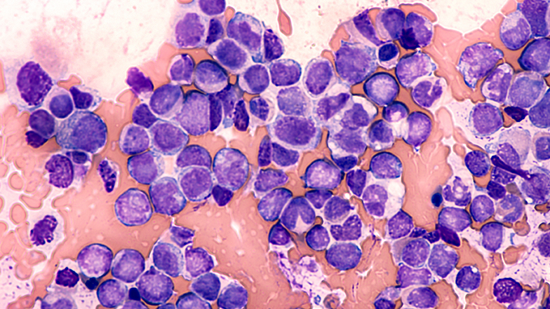 Blast cells from Acute Myeloid Leukemia